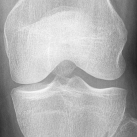 Clasificación Automática de Osteoartritis de Rodilla
